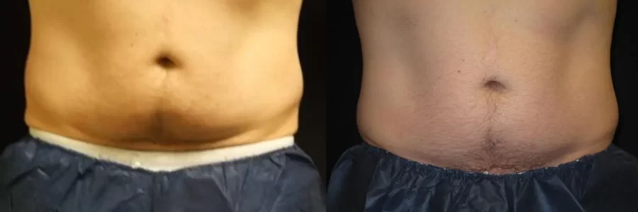 Coolsculpting before and after results