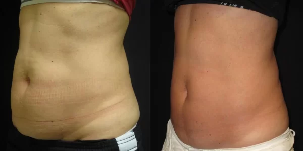 Coolsculpting before and after results