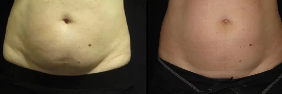 Coolsculpting before and after results