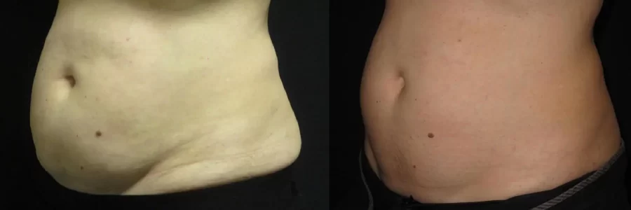 Coolsculpting before and after results