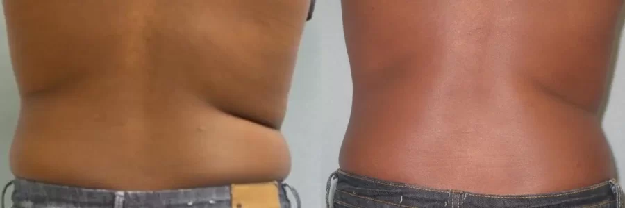 Coolsculpting before and after results