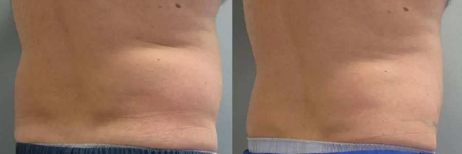 Coolsculpting before and after results