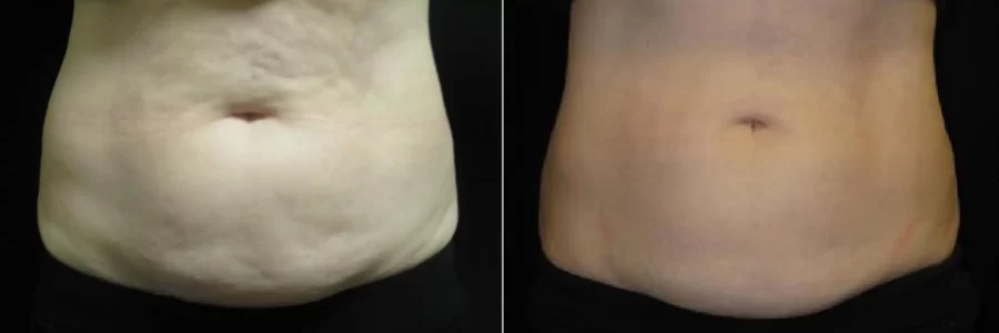 Coolsculpting before and after results