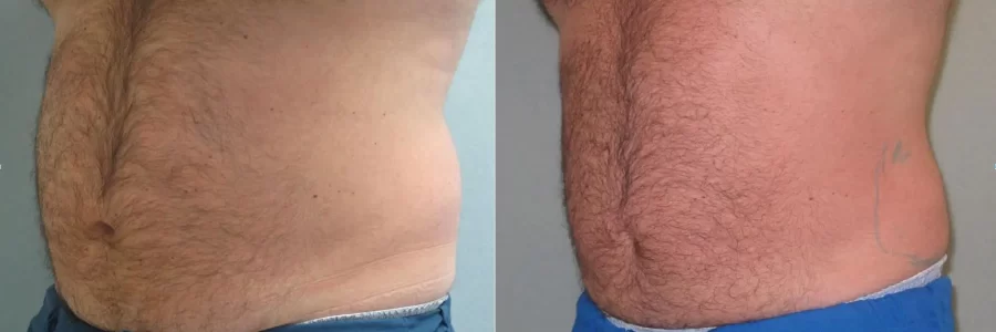 Coolsculpting before and after results