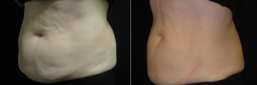 Coolsculpting before and after results