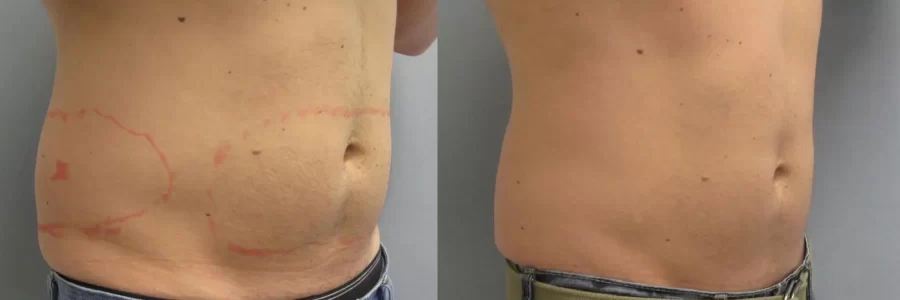 Coolsculpting before and after results