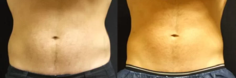 Coolsculpting before and after results