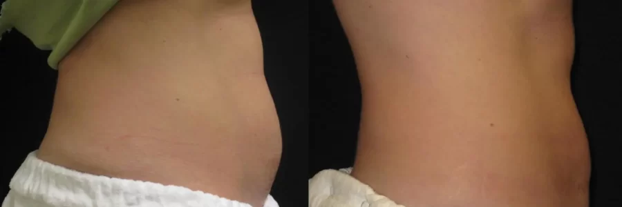 Coolsculpting before and after results