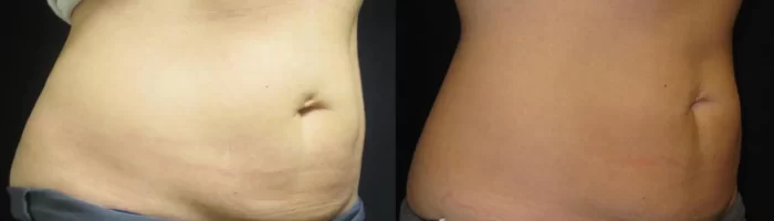 Coolsculpting before and after results