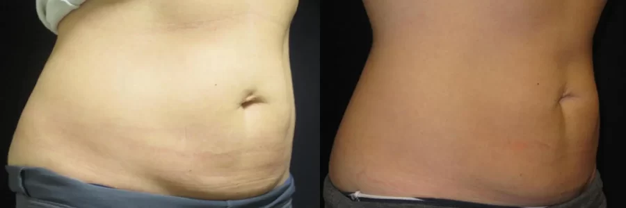 Coolsculpting before and after results