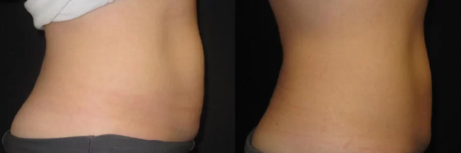 Coolsculpting before and after results