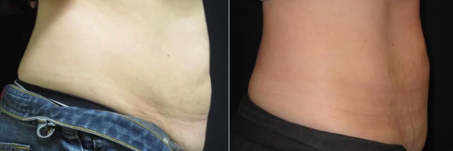 Coolsculpting before and after results