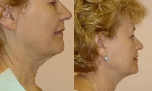 Facelift patient before & after results.