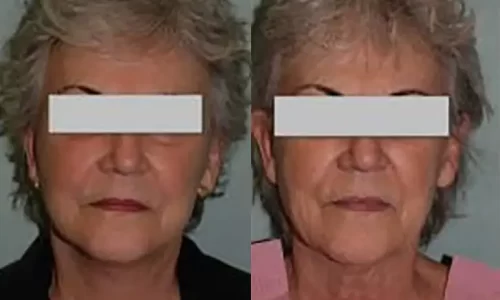 Facelift patient before & after results.