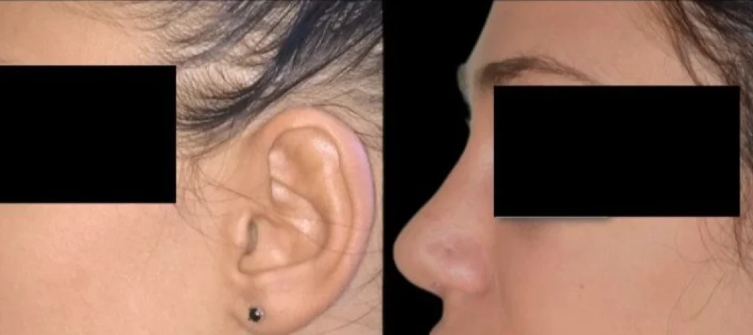 Rhinoplasty 1