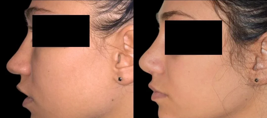 Rhinoplasty ba 5