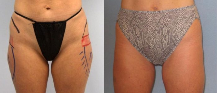 Smartlipo & Vaser Lipo patient before & after results.