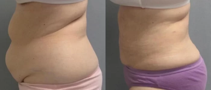 Smartlipo before and after results