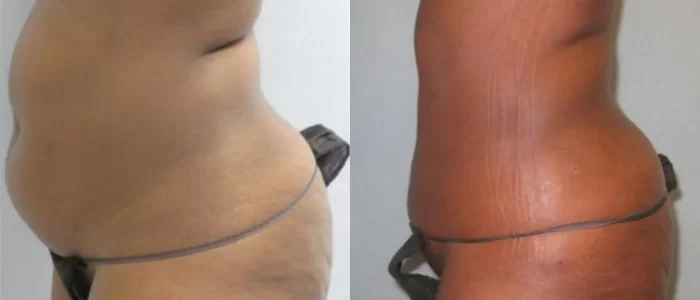 Smartlipo before and after results