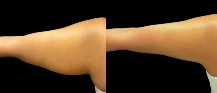 Smartlipo, Arms, Hispanic, Female