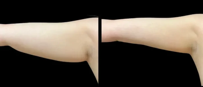Smartlipo, Arms, White, Female