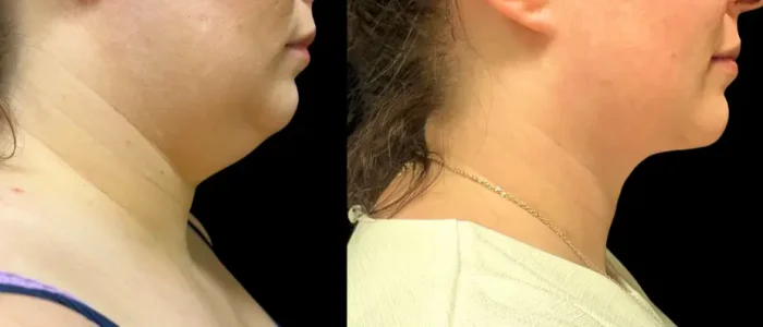 Smartlipo, Chin, White, Female