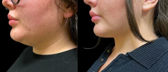 Smartlipo, Female 20-25yo, White, Chin