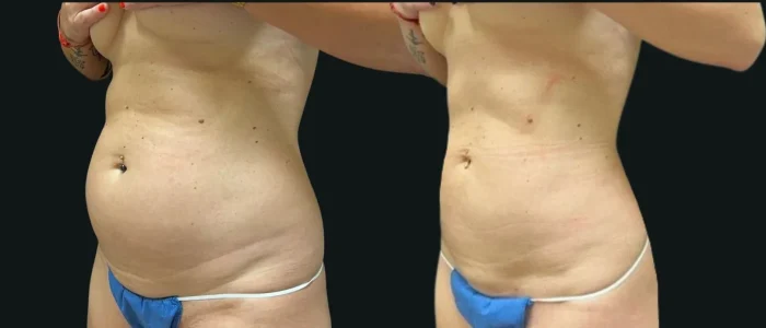 Smartlipo, Female, Abdomen, Flanks