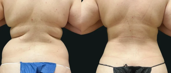 Smartlipo, Female, Back and Flanks