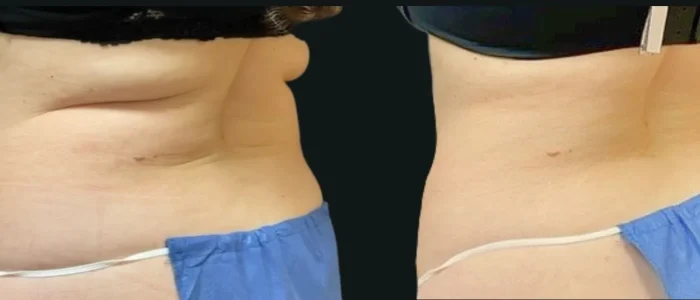 Smartlipo, Female, Bra Buldge, Mid Back