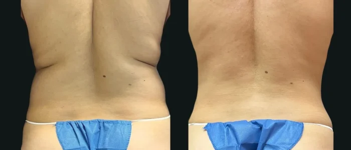 Smartlipo, Female, Hispanic, Back and Flanks