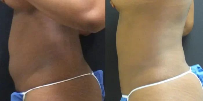Smartlipoo patient before and after results