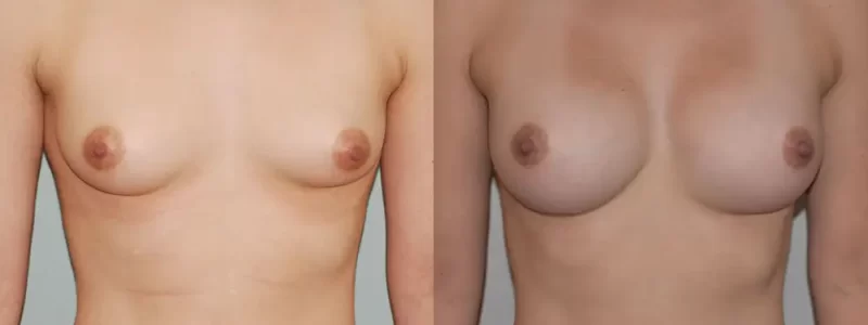 Breast augmentation patient before & after results.