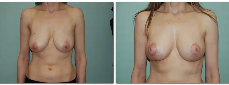 Breast lift before and after results