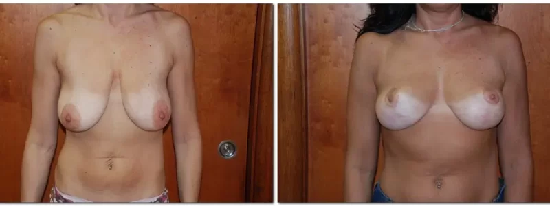 Breast lift before and after results