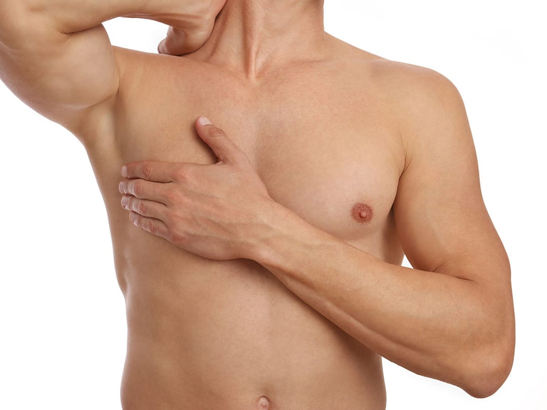 Gynecomastia
