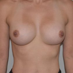 Breast Augmentation Before & After Patient #233