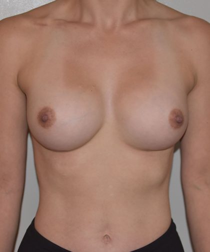 Breast Augmentation Before & After Patient #233