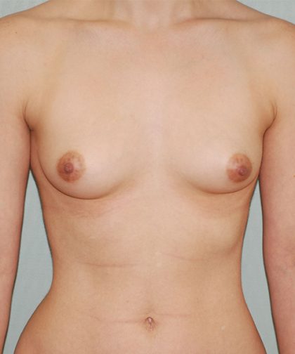Breast Augmentation Before & After Patient #233