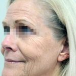 Fractional CO2 Laser Before & After Patient #2302