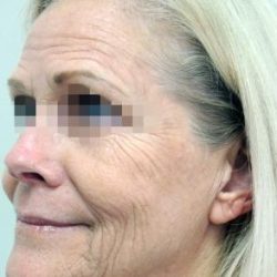 Fractional CO2 Laser Before & After Patient #2302
