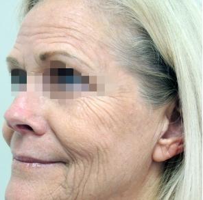 Fractional CO2 Laser Before & After Patient #2302