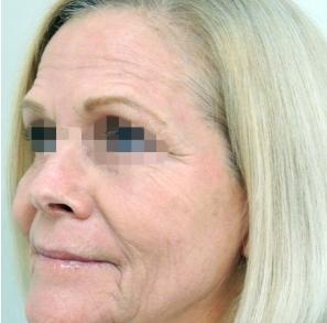 Fractional CO2 Laser Before & After Patient #2302