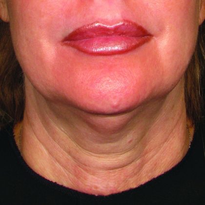 Ultherapy Before & After Patient #345