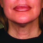 Ultherapy Before & After Patient #345