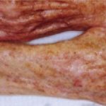 Fractional CO2 Laser Before & After Patient #2305