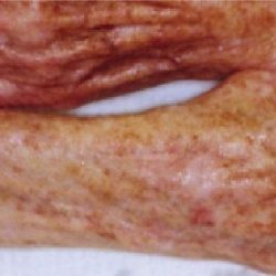 Fractional CO2 Laser Before & After Patient #2305