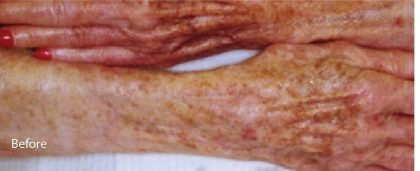 Fractional CO2 Laser Before & After Patient #2305