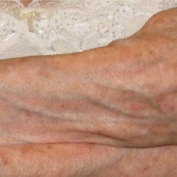 Fractional CO2 Laser Before & After Patient #2305