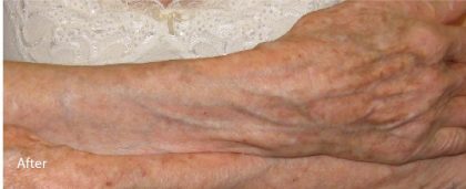 Fractional CO2 Laser Before & After Patient #2305